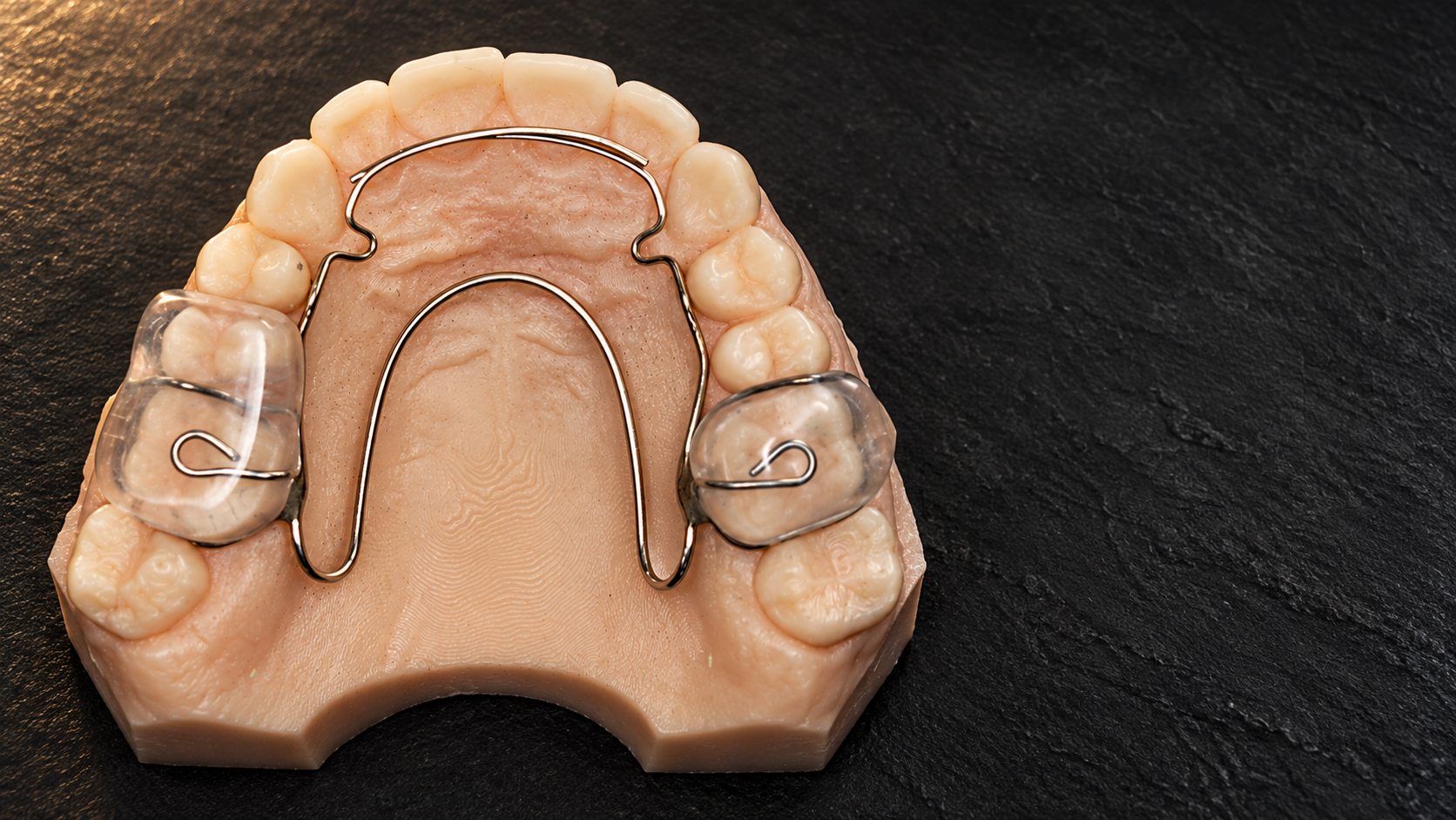 Authentic Open Loop Cricket craniofacial appliance on an upper dental arch, showing the anterior bow, open palatal wire and clear posterior acrylic components